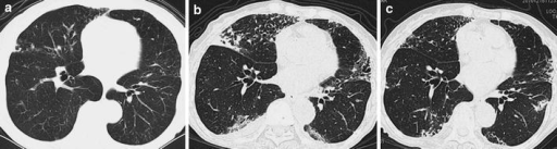 a A CT scan of case 8 before the development of NTM dis | Open-i