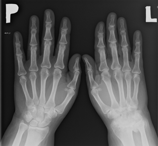 X-ray of hands: Ankylosis of the left wrist in a patien | Open-i