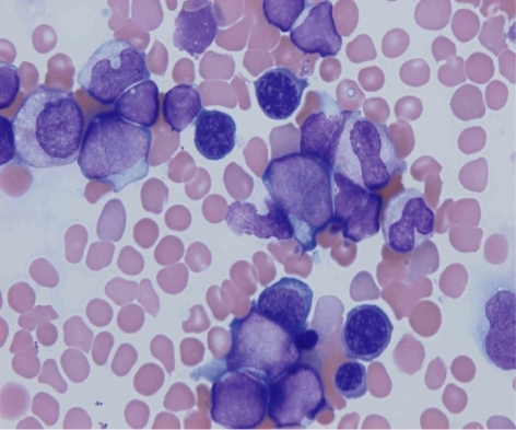 Bone marrow smear. (May-Gimza stain ×1000). Bone marro | Open-i