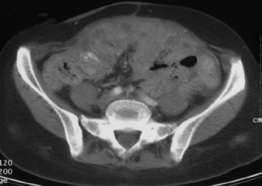 ovarian cancer on ct scan)