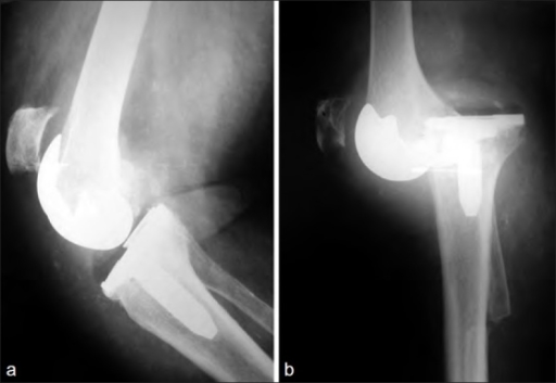 (a) Reduced Prostheses After Dislocation. Notice The Hi | Open-i