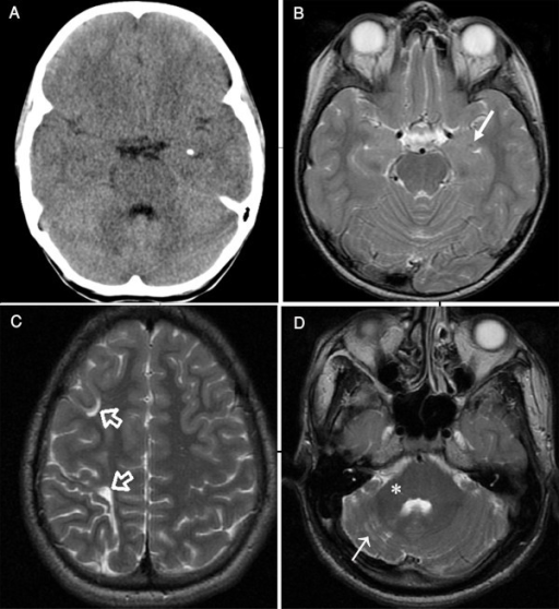 Brain CT and MRI of Patients 1 and 2. (a) Brain CT imag | Open-i