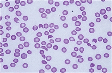 Wright Stained Peripheral Blood Smear Before A And After B