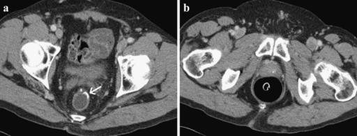 Lower anterior resection. a Axial contrast-enhanced CT | Open-i