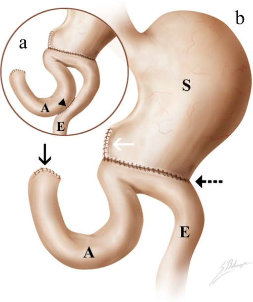 Illustration of Billroth type 2 procedure. a A side-to- | Open-i