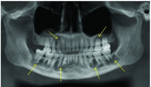 Florid cemento-osseous dysplasia seen as mixed predomin | Open-i