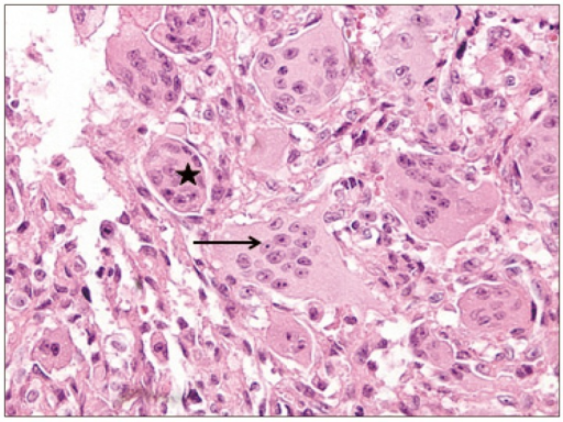 Photomicrograph shows that the tumor is composed of rou | Open-i