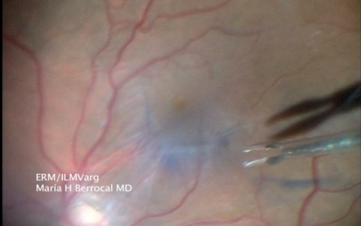 Use Of Brilliant Blue G BBG During Epiretinal Membrane ERM Removal Use Of Brilliant Blue G BBG During Epiretinal Membrane ERM Removal