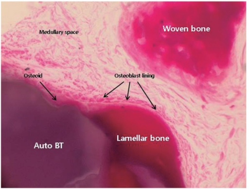 woven bone histology