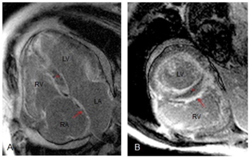 Cardiac MRI.(A) Four-chamber view demonstrating hyper e | Open-i