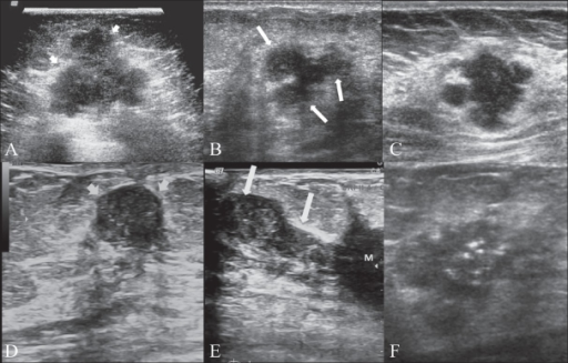 Malignant lesions. Transverse scan (A) shows a typical | Open-i