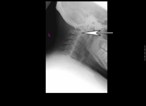 Lateral Cervical Spine X Ray Demonstrating Loss Of Norm Open I 9147