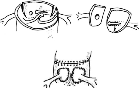 Individual coronary button technique. | Open-i