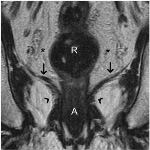 Coronal T2-weighted turbo spin-echo MR image shows the | Open-i