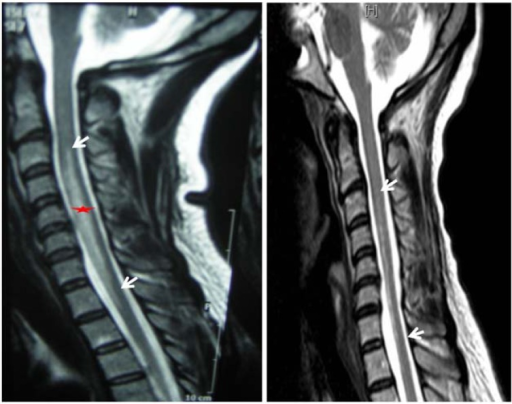 Left: hyperintense intramedullary lesion in T2 at the l | Open-i