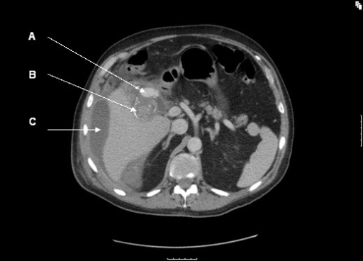 CT angiogram (A = cystic artery pseudoaneurysm; B = cal | Open-i