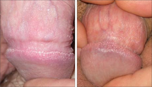 Papules On The Penis 120