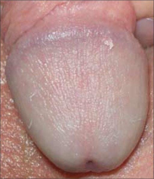 Pearly Papules Penis 110