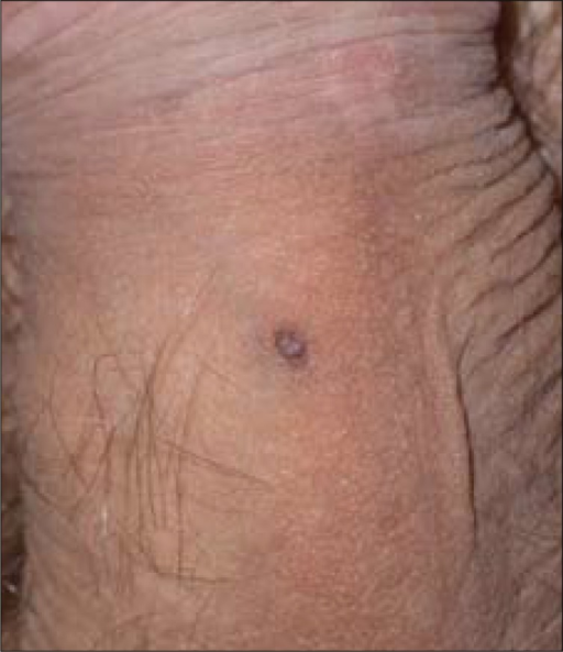 Skin Tags On Penis Shaft 79