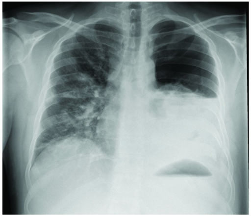 Chest Radiograph Showing A Hemopneumothorax Of The Left Open I