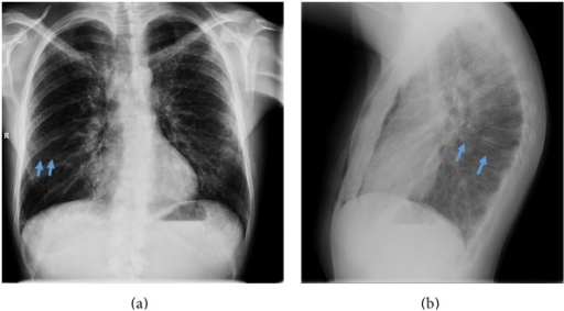 Plain X-rays. (a) anteroposterior X-ray; (b) lateral X- | Open-i