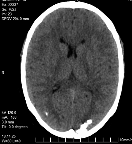 CT Scan showing bilateral calcification in occipital re | Open-i