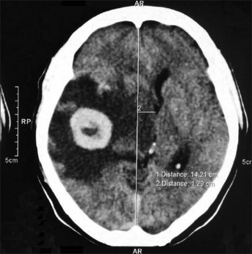 CT-scan brain showing brain metastases | Open-i