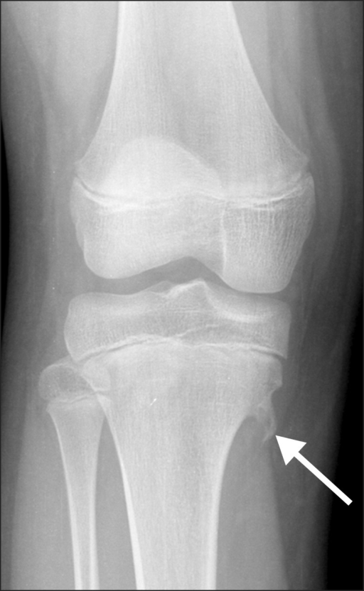 Osteochondroma is a benign tumor characterized by an ov | Open-i