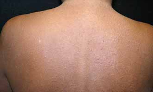 Micropapular rash on the trunk | Open-i