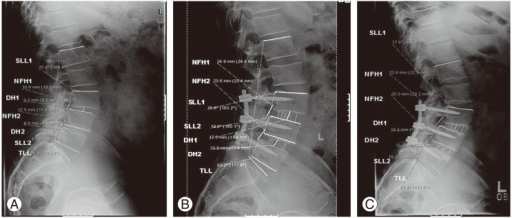 A 57 Year Old Male With Lumbar Spinal Stenosis And Spon Open I