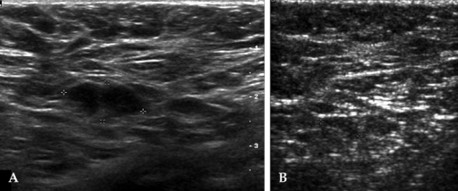 A 40 Year Old Woman With Left Modified Radical Mastecto Open I 