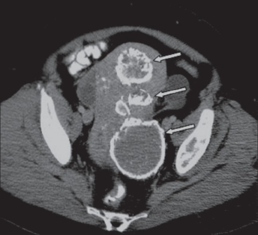 A 51 Year Old Woman Known To Have Fibroids Which Have Open I 6878