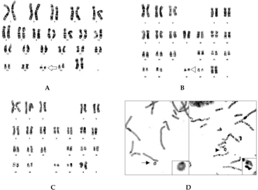 The results of our cytogenetic studies. (A) The patient | Open-i