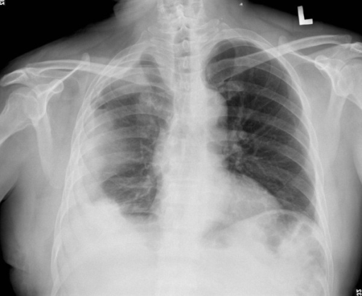 Chest roentgenogram. Plain chest film showed right-side ...