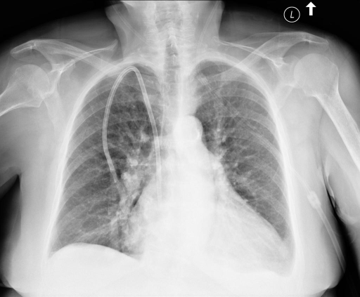 Lateral Chest Radiograph Anatomy