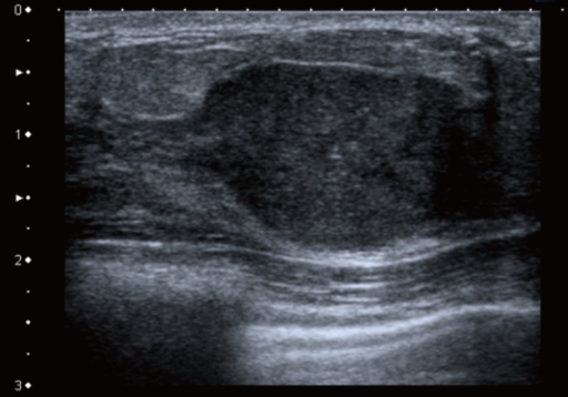 Breast Ultrasound Shows A Well Defined Hypoechoic Sol Open I