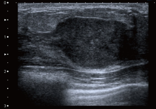 breast-ultrasound-shows-a-well-defined-hypoechoic-sol-open-i