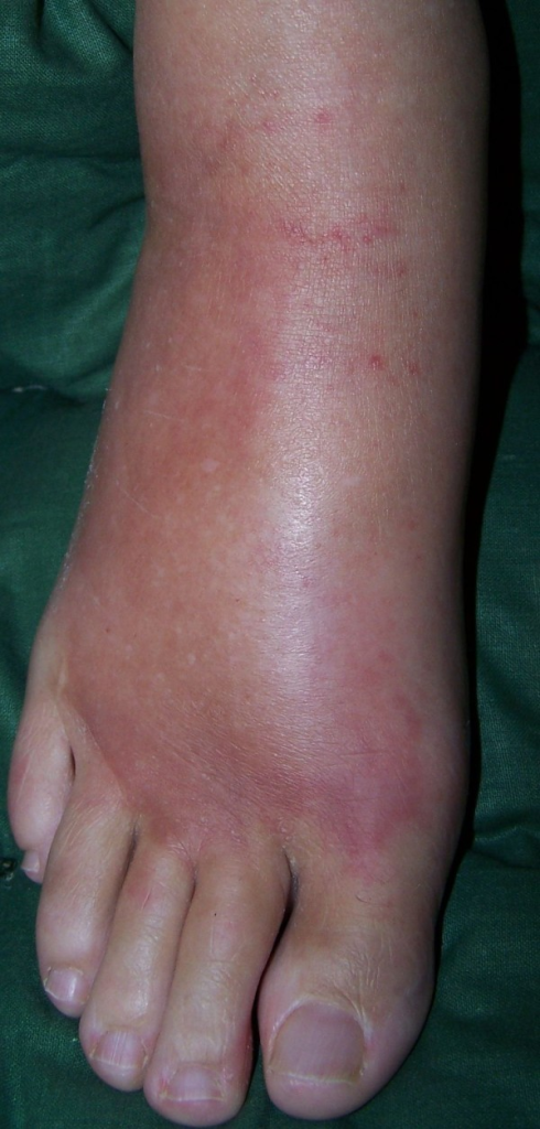 Appearance Of The Case Patient S Right Foot Hot Red Open I