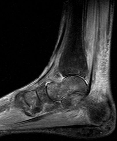 Same foot as in Figure 1. MRI sagittal STIR-sequence sh | Open-i