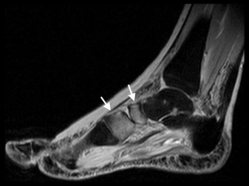Same foot as in Figure 5. MRI sagittal STIR-sequence sh | Open-i