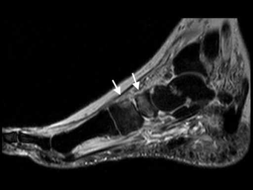 Same foot as in Figure 7. MRI sagittal STIR-sequence sh | Open-i