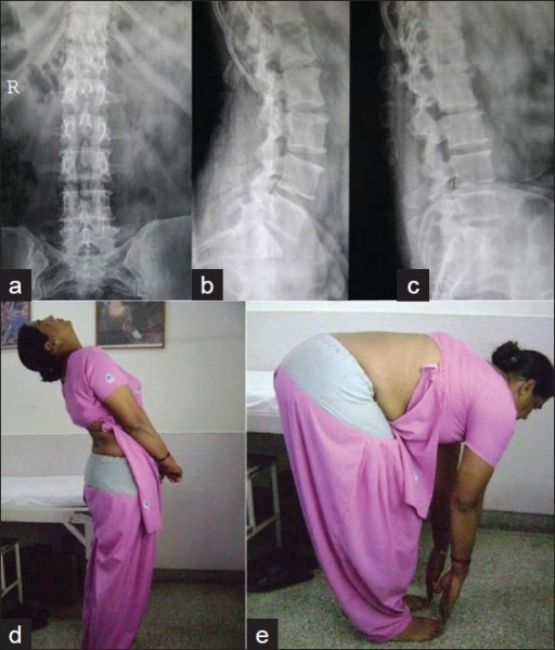 flexion extension x ray cervical spine
