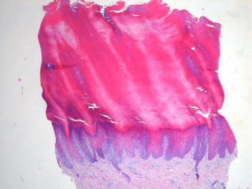 Histology of a focal plantar keratosis showing massive | Open-i