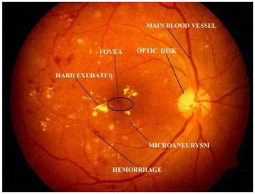 automated diabetic retinopathy detection system Objective —to evaluate the performance of a system for automated detection of diabetic retinopathy in digital retinal photographs, built from published algorithms, in a large, representative, screening population research design and methods —we conducted a retrospective analysis of 10,000 consecutive patient visits, specifically exams. automated diabetic retinopathy detection system Objective —to evaluate the performance of a system for automated detection of diabetic retinopathy in digital retinal photographs, built from published algorithms, in a large, representative, screening population research design and methods —we conducted a retrospective analysis of 10,000 consecutive patient visits, specifically exams.
