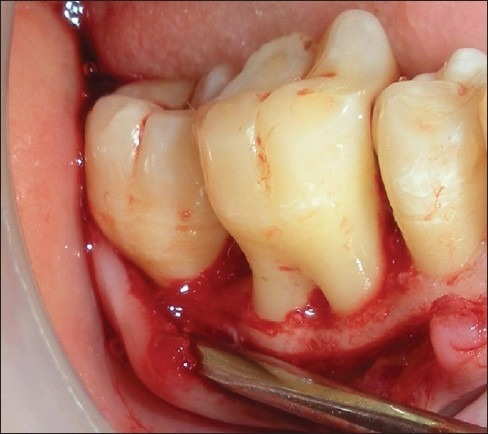 Furcation defect upon flap elevation (control) | Open-i