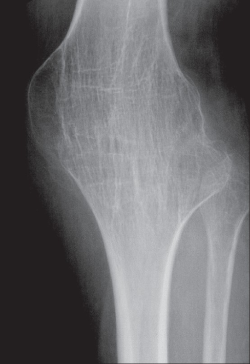 Plain radiograph shows bony ankylosis of the left knee, | Open-i