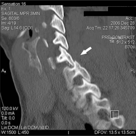 Locked facets on computed tomography (CT). The reconstr | Open-i