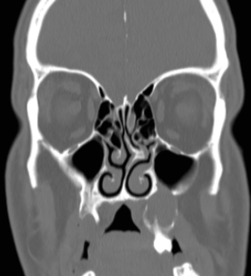 Coronal section shows calcification of falx cerebri and | Open-i