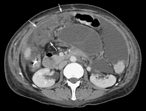 Ovarian cancer in a 51-year-old woman. CT image shows e | Open-i