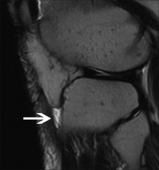 Deep infra patellar bursitis. A 27-year-old male presen | Open-i